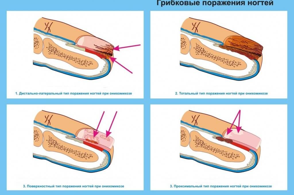 Первые признаки онихомикоза на руках, лечение и профилактика недуга