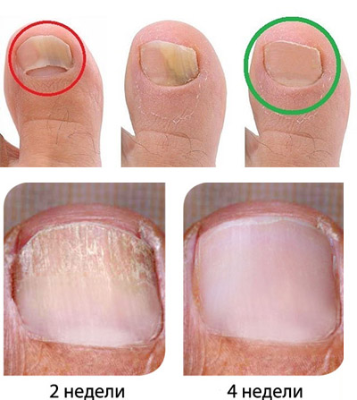 Обзор мази крема Тербинафин с применением от грибка ногтей