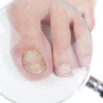 Спрей от грибка ногтей на ногах Термикон: отзывы и аналоги