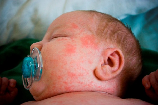 аллергия пятнами у ребенка 