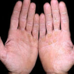Микоз кистей рук: симптомы и лечение грибка