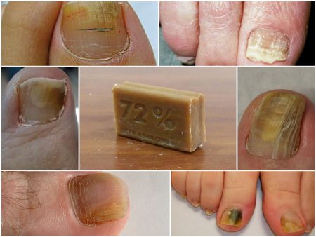 Лечение грибка ногтей на ногах хозяйственным мылом