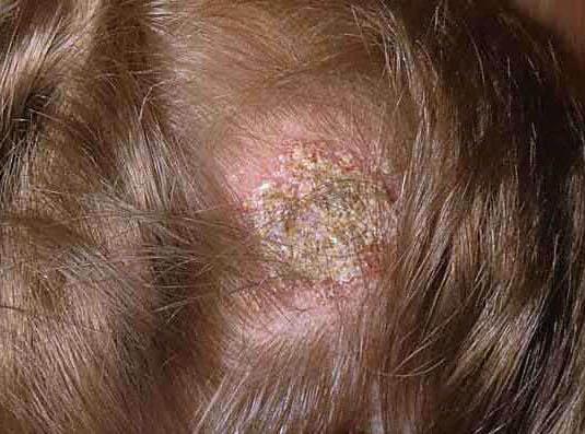 Что такое микоз кожи симптомы и лечение грибкового заболевания