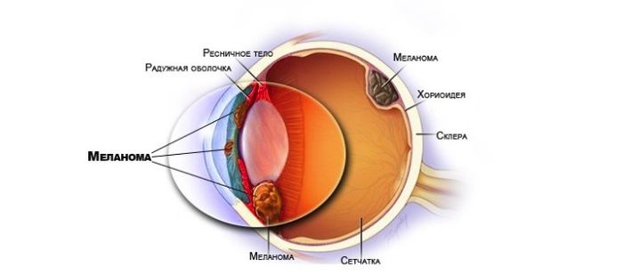 Меланома на зрачке глаза