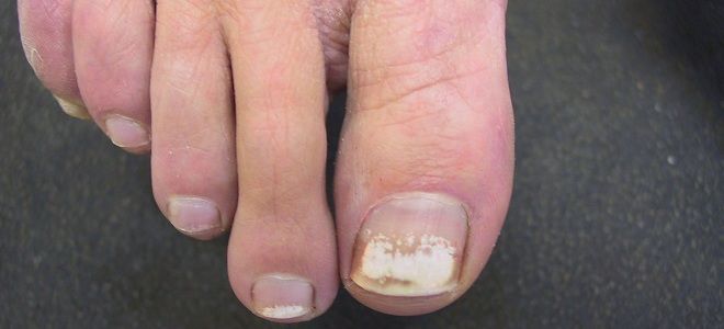 Почему на ногтях появляются белые или черные пятна