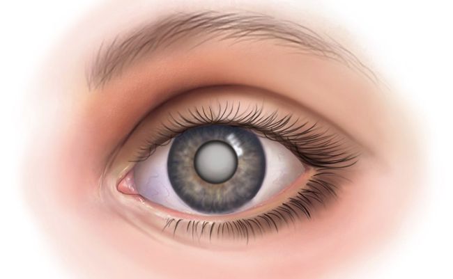 Заболевание глаз – катаракта