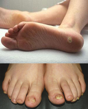 Мазь от грибка на ногах между пальцами