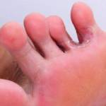 Микоз между пальцами ног: чем лечить грибок?