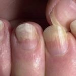 Как выглядит грибок ногтей на руках: симптомы и лечение
