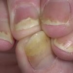 Как вылечить псориаз ногтей, медикаментозно и народными средствами?