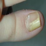 Можно ли лечить грибок ногтей во время беременности?