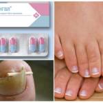 Таблетки Орунгал от грибка ногтей: инструкция по применению и аналоги препарата