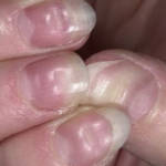 Вмятины на ногтях больших пальцев рук: причины и лечение