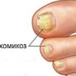 Бинафин от грибка ногтей: формы выпуска, отзывы и аналоги