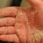 Причина шелушения кожи на пальцах рук: симптомы и лечение