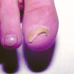 Удаление вросшего ногтя на ноге хирургическим путем и лазерным методом