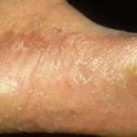 Заболевания стопы ног: фото грибка стопы и ногтей, лишая