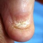 Заболевания ногтей на ногах: фото и причины, лечение