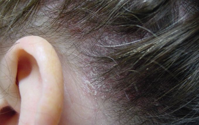 Чем лечить псориаз волосистой части головы