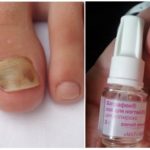 Противогрибковый лак для ногтей: самый эффективный препарат