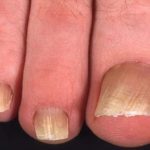 Как избавиться от грибка ногтей: лечение без таблеток и эффективными препаратами