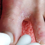 Чем лечить грибок ногтей и стопы?