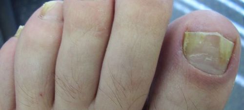 Яблочный уксус в борьбе с грибком ногтей на ногах