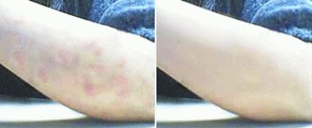 Удобно и эффективно китайские пластыри Нежная кожа и Quannaide Xinmeisu Tiegao в лечении псориаза
