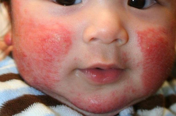 аллергия на лице 