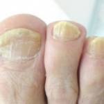 Дерматофития: симптомы и лечение, фото поражения ногтей и ступней