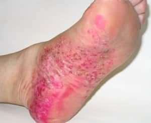 Симптомы, виды, лечение псориаза на ногах