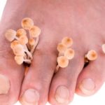 Трескается кожа на пальцах ног: причины и лечение