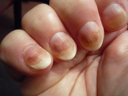 Дрожжевой грибок на ногтях рук лечение