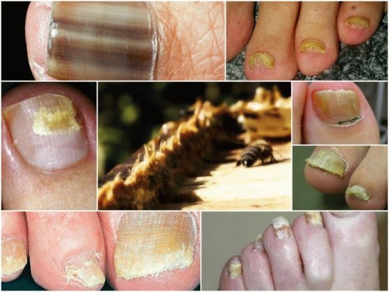 Как вылечить грибок ногтей прополисом