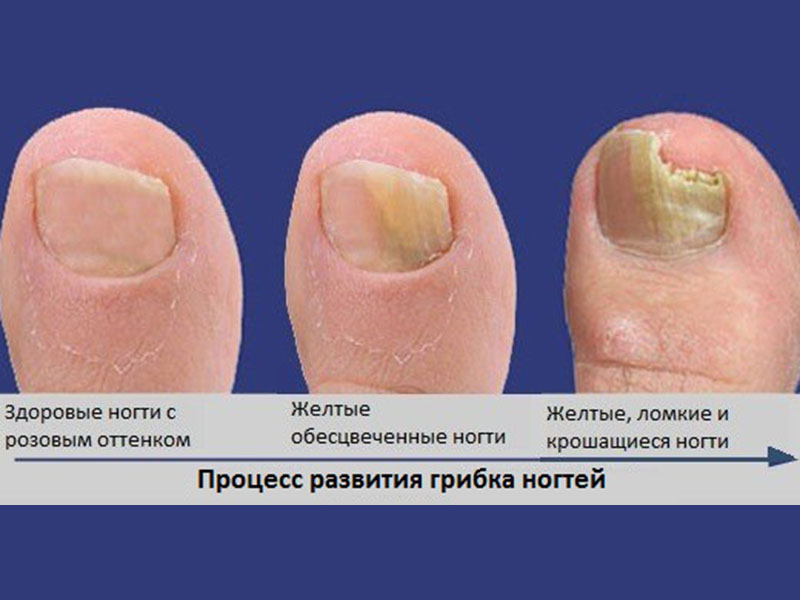 Лечебные свойства лака от микоза ногтей способствующие избавлению от грибка ногтей на руках и ногах