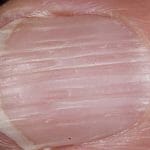 Вертикальные полосы на ногтях рук: причины и лечение