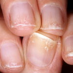 Деформация ногтей на руках: причины и лечение