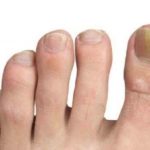 Листерин от грибка ногтей: инструкция по применению ополаскивателя