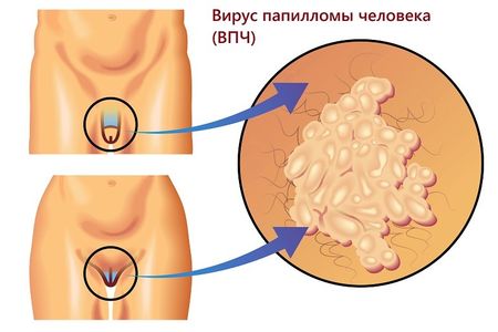 Что такое аногенитальные венерические бородавки причины и методы лечения