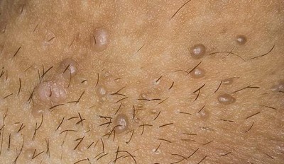 Аногенитальные бородавки кондиломы