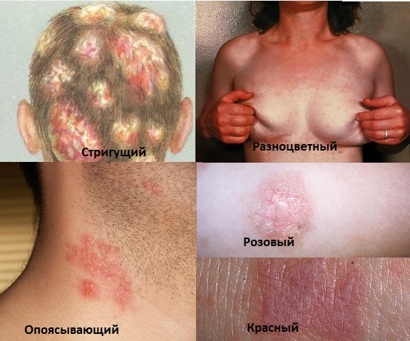 Что такое микоз кожи симптомы и лечение грибкового заболевания