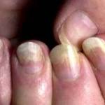 Дрожжевой грибок на ногтях и коже: причины и лечение