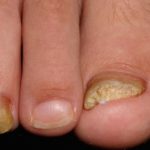 Изменение ногтевой пластины на руках: почему ногти становятся ребристыми?