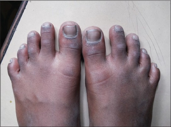 Причины, почему чернеют ногти на ногах у женщин. Как лечить ногти
