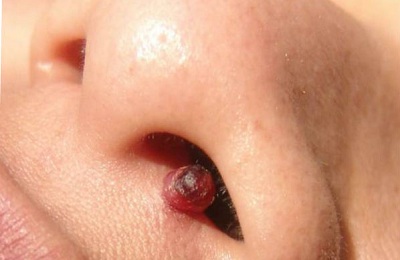 Способы лечения инвертированной папилломы носовой полости