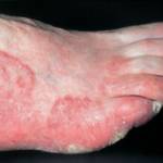 Руброфития: причины и симптомы на коже и ногтях