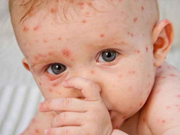 аллергия пятнами у ребенка 