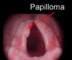 Что такое папиллома и как лечить нарост на гортани