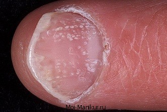 Чем лечить псориаз ногтей на ногах, фото пораженных пластин