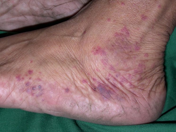 Причины развития и лечение гиперкератотической дермофитии стопы